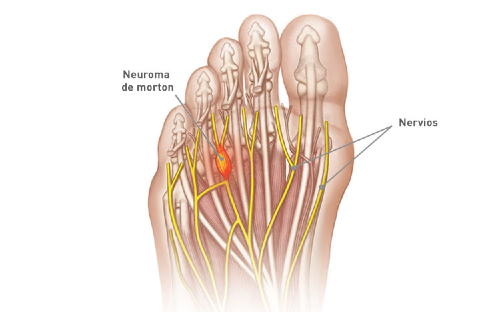 neuroma de Morton