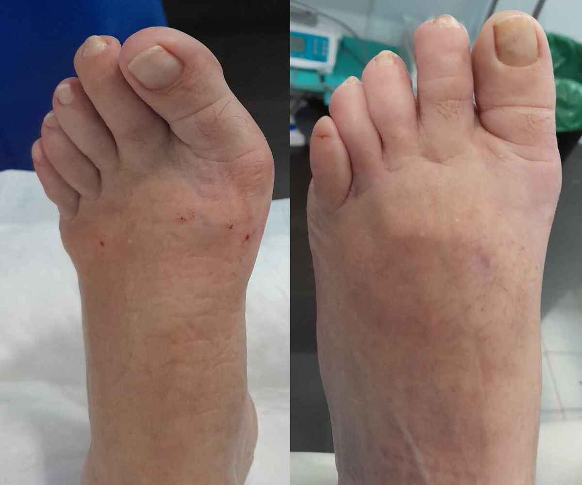 cirugia minima incision juanete hallux valgus