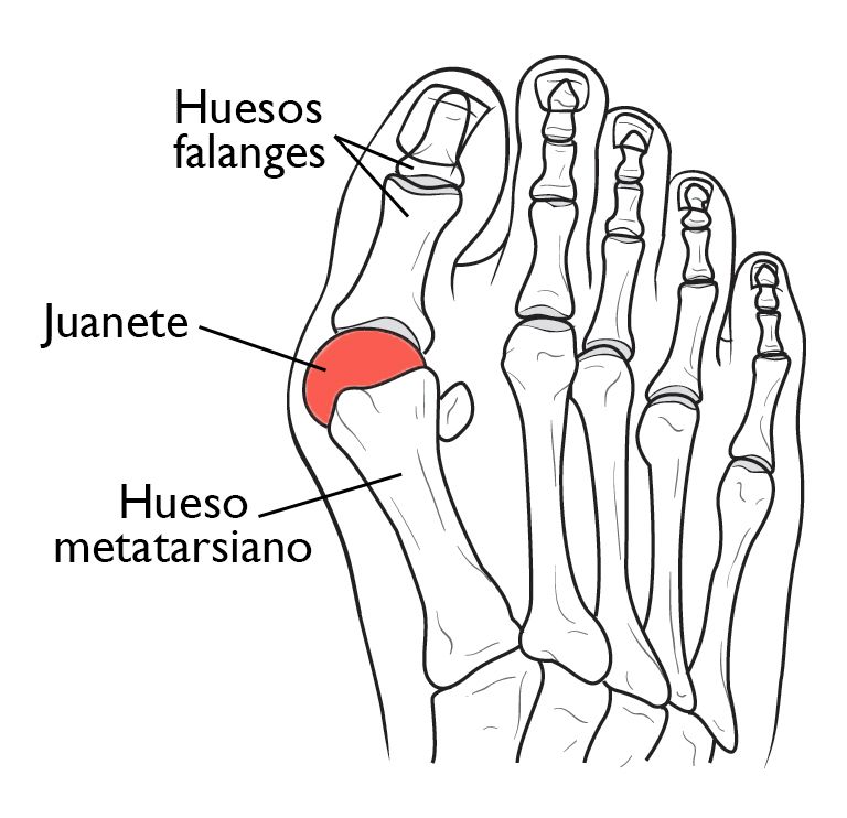 dibujo juanete hallux valgus