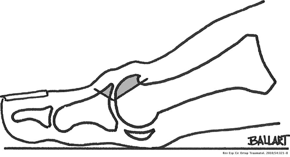 figura1 hallux rigidus