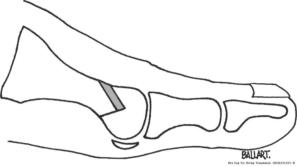 figura 2 hallux rigidus