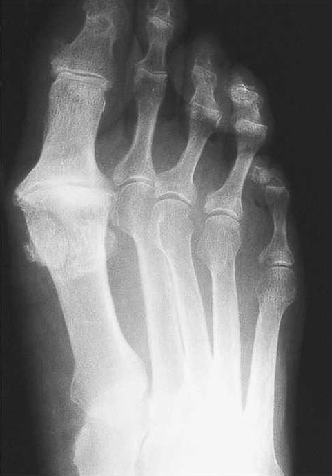 radiografia hallux rigidus